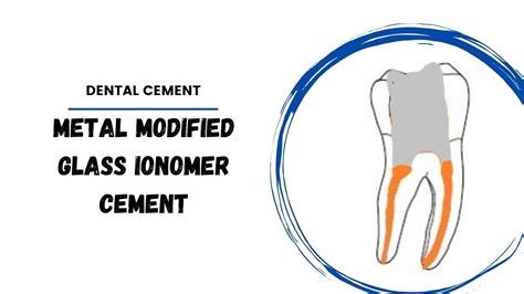  Ionomers de Metal: Revolucionando a Engenharia Biomédica com Implantes Dentários Duradouros e Flexíveis!